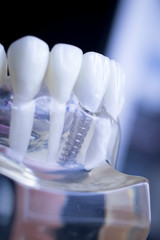Dentist dental teeth implant