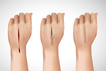 Obraz premium Surgical Stitching Hands Composition