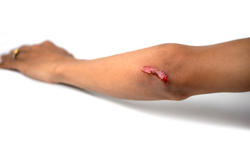 Picture shows fresh wounds to the elbow after exercise isolated on white background.