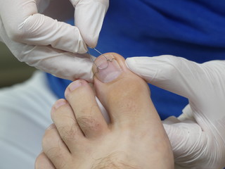 Nagelspange, Orthonyxiespange bei einem eingewachsenen Nagel