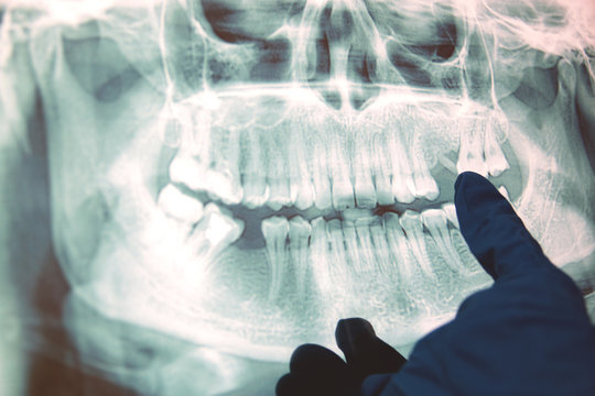 Panoramic x-ray image of teeth. Some teeth removed, problem with teeth