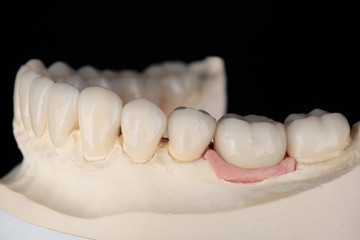 Fototapeta na wymiar Dental veneers and crowns on the model of the patient