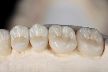 high quality ceramic Dental crowns, gum of the jaw