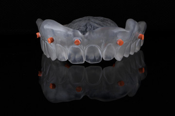vaksap - digital impression of the upper jaw 3d printing, shot on black mirror with otradeniem © Dental Pro Content