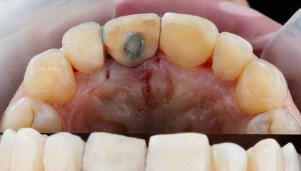 view from inside the installed Dental crown