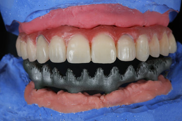 ceramic prosthesis upper-jaw and the bottom beam titanium vvide