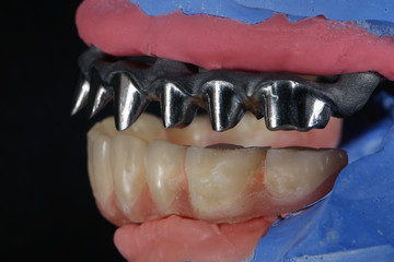 titanium prosthesis beam and the lower jaw Dental model, side view close-up