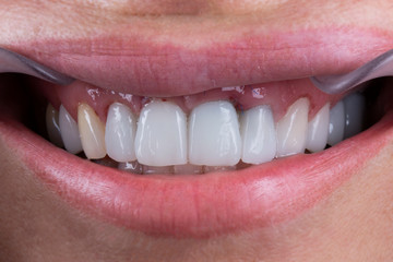 Fototapeta premium photo of the patient smiles with porcelain crowns on the central incisors