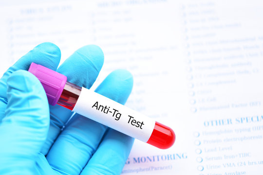 Blood sample tube for anti-Tg or anti-thyroglobulin test, diagnosis for thyroid hormone disease
