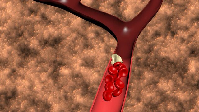 Animation of the formation of thrombosis