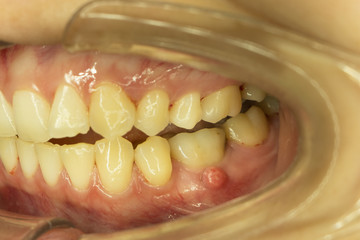 gum swelling from dental root abscess