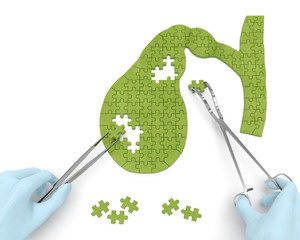 Gallbladder puzzle concept: hands of surgeon with surgical instruments perform gall bladder surgery as a result of cholelithiasis, cholecystitis, cholecystectomy, biliary dyskinesia