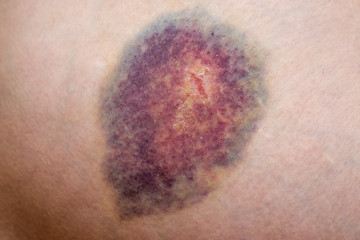 Closeup on a Bruise on wounded woman leg skin. Close up on a bruise on wounded woman leg skin....