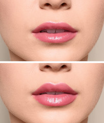 Woman before and after lips augmentation procedure, closeup. Cosmetic surgery