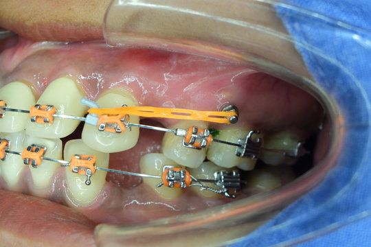 miniscrew and elastic chain in orthodontic treatment