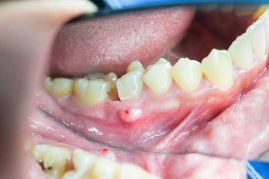dental root abscess from decayed tooth