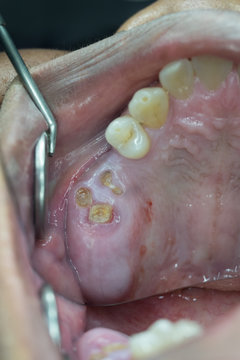 root of tooth from decayed