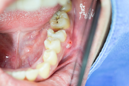 close up of gum swelling on lower back teeth