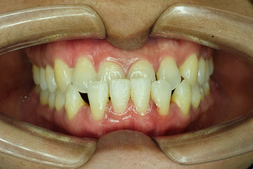 underbite malocclusion