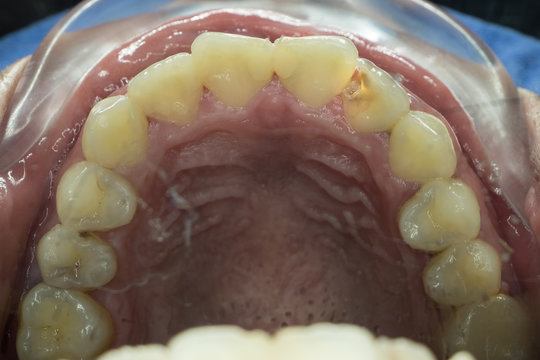 decayed tooth