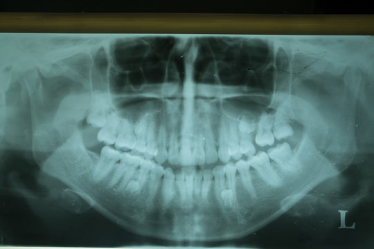 panoramic Xray film show impacted wisdom teeth