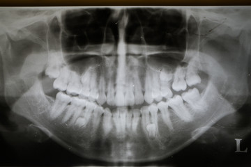 bicuspid teeth impaction in panoramic film
