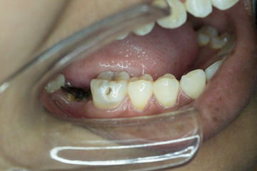 decayed tooth in lower molar tooth