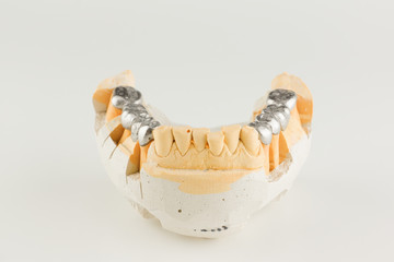 bases of metal-cast bridges