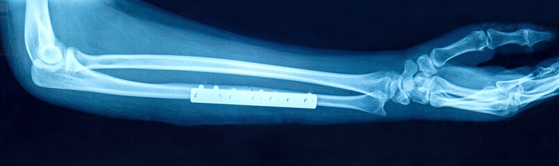 Film x-ray show fracture shaft of arm insert plate and screw for fix arm’s bone