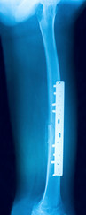 Film x-ray show fracture shaft of femur insert plate and screw for fix leg’s bone