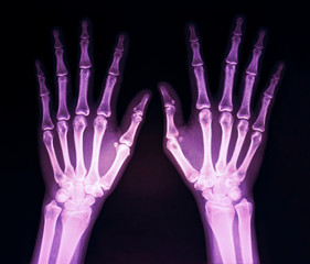 Film x-ray normal both human’s hands in magenta color