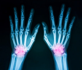 Film x-ray both human's hands and wrist arthritis, marking in red color