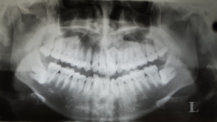 panoramic Xray film show impacted wisdom teeth