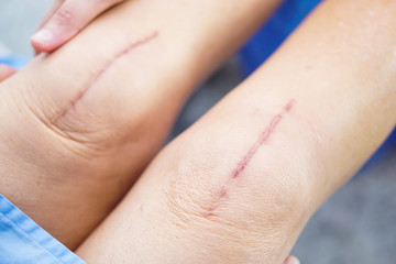 Asian senior or elderly old lady woman patient show her scars surgical total knee joint replacement Suture wound surgery arthroplasty on bed in nursing hospital ward : healthy strong medical concept.