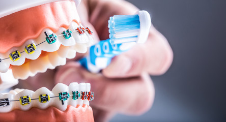 Close-up teeth braces and tooth brush as an example of toothbrushing
