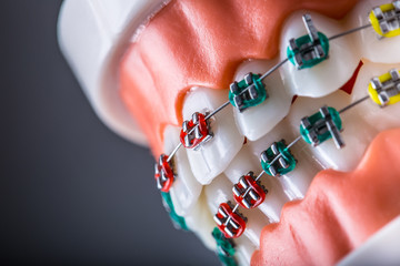 Close-up of a orthodontic model jaws and teeth with braces