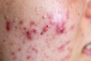 Fototapeta premium Backgrounds of lesions skin caused by acne on the face in the clinic.