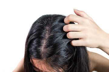 women head with dandruff Caused by the problem of dirty. Or caused by skin disease or Seborrheic...