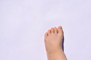 The usual flat wart on the child's toe. - obrazy, fototapety, plakaty