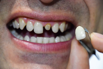 Dental prosthesis of metal ceramics in tweezers. A patient without a tooth is trying on a denture....