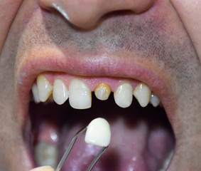 Fototapeta premium Dental prosthesis of metal ceramics in tweezers. A patient without a tooth is trying on a denture. Tooth implantation, dental treatment.