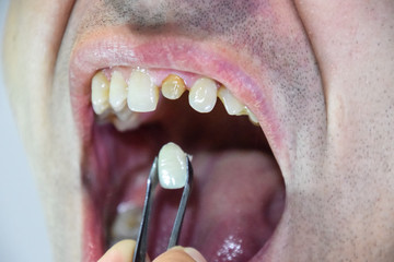 Dental prosthesis of metal ceramics in tweezers. A patient without a tooth is trying on a denture....