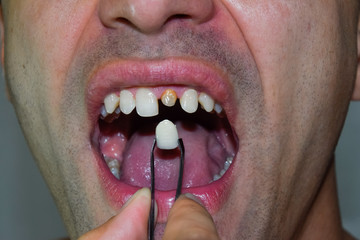 Dental prosthesis of metal ceramics in tweezers. A patient without a tooth is trying on a denture....