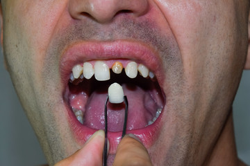 Dental prosthesis of metal ceramics in tweezers. A patient without a tooth is trying on a denture. Tooth implantation, dental treatment.