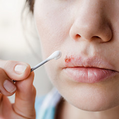 Part of a young woman's face with a virus herpes on lips, treatment with ointment