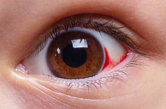 Eye disease. Red eyes.