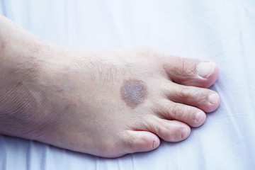 Dermatitis foot have a dark, circular appearance.