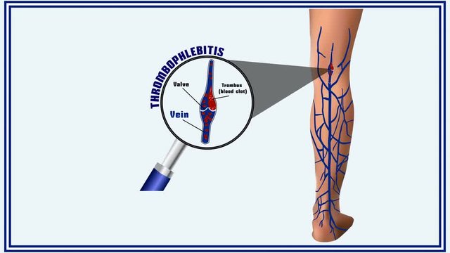Thrombophlebitis, blood clots in the veins. Embolism. Thrombosis. Phlebemphraxis. Animations.