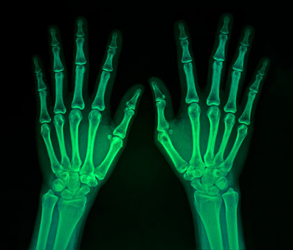 Film x-ray normal both human’s hands in green color