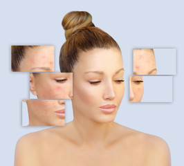 Post-Acne Marks /Treating Acne Scars